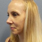 Rhinoplasty Before & After Patient #10061