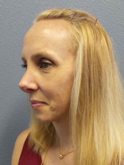 Rhinoplasty Before & After Patient #10061