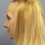Rhinoplasty Before & After Patient #10061