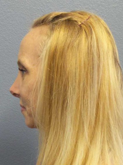 Rhinoplasty Before & After Patient #10061
