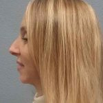 Rhinoplasty Before & After Patient #10061