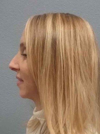 Rhinoplasty Before & After Patient #10061