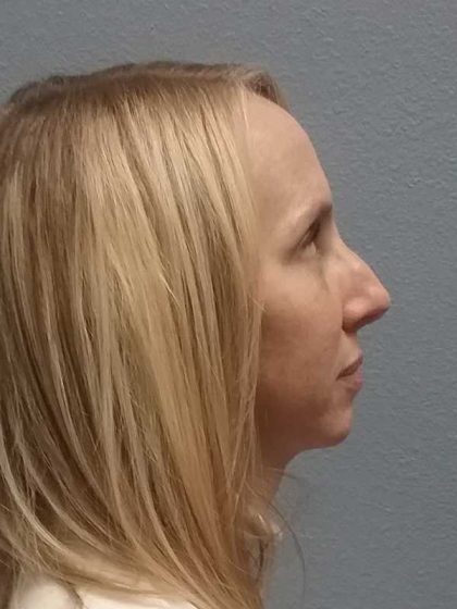 Rhinoplasty Before & After Patient #10061