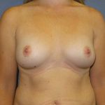 Breast Augmentation Before & After Patient #6931