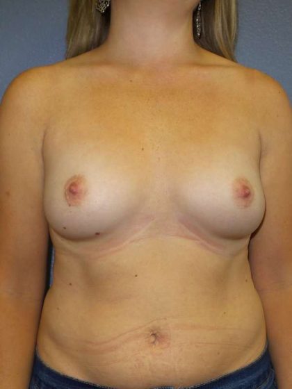 Breast Augmentation Before & After Patient #6931