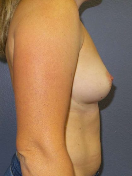 Breast Augmentation Before & After Patient #6931