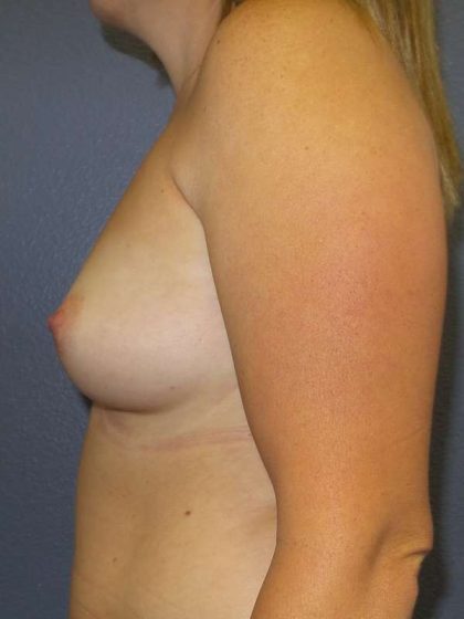 Breast Augmentation Before & After Patient #6931