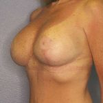 Breast Lift with Implant (Augmentation Mastopexy) Before & After Patient #4209