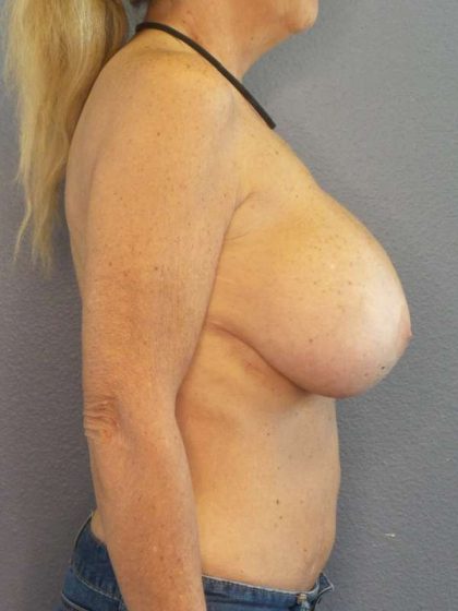 Breast Lift with Implant (Augmentation Mastopexy) Before & After Patient #4209
