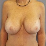 Breast Lift with Implant (Augmentation Mastopexy) Before & After Patient #4209