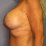 Breast Lift with Implant (Augmentation Mastopexy) Before & After Patient #4209