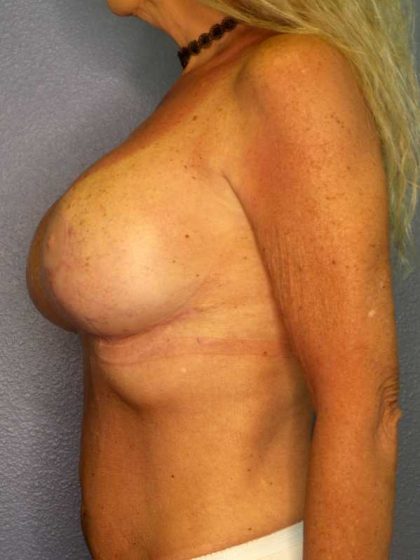 Breast Lift with Implant (Augmentation Mastopexy) Before & After Patient #4209