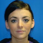Rhinoplasty Before & After Patient #12406