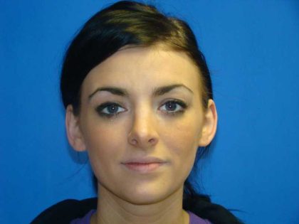 Rhinoplasty Before & After Patient #12406