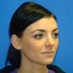 Rhinoplasty Before & After Patient #12406