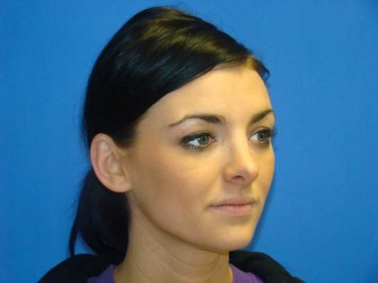 Rhinoplasty Before & After Patient #12406