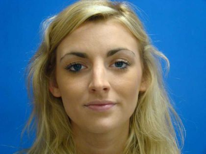 Rhinoplasty Before & After Patient #12406