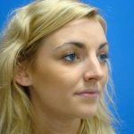 Rhinoplasty Before & After Patient #12406