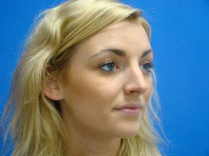 Rhinoplasty Before & After Patient #12406