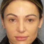Rhinoplasty Before & After Patient #9781