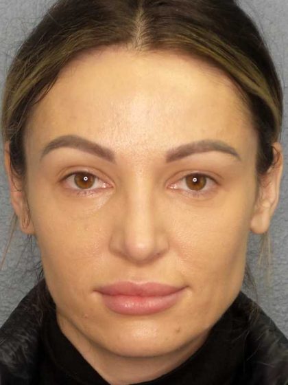 Rhinoplasty Before & After Patient #9781