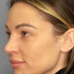 Rhinoplasty Before & After Patient #9781