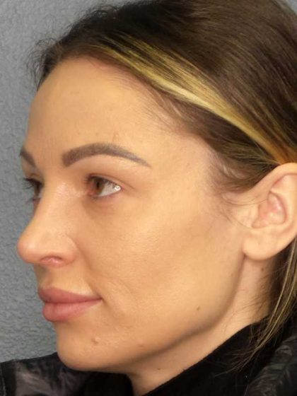 Rhinoplasty Before & After Patient #9781