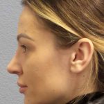 Rhinoplasty Before & After Patient #9781