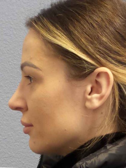 Rhinoplasty Before & After Patient #9781