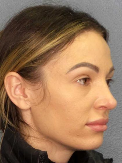Rhinoplasty Before & After Patient #9781