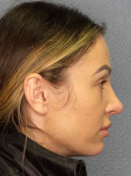 Rhinoplasty Before & After Patient #9781
