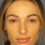 Rhinoplasty Before & After Patient #9781