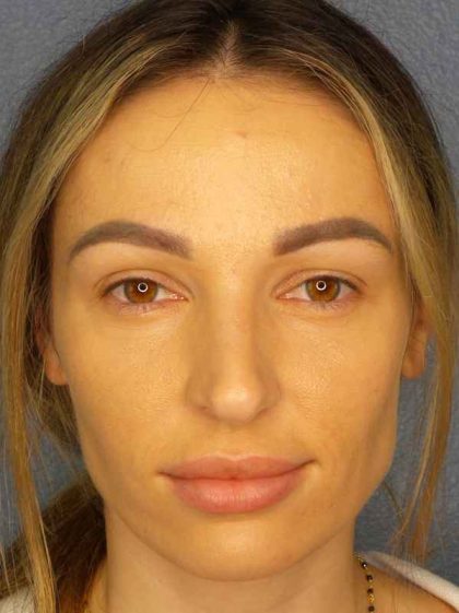 Rhinoplasty Before & After Patient #9781