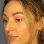 Rhinoplasty Before & After Patient #9781