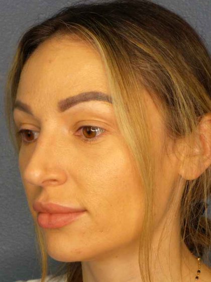 Rhinoplasty Before & After Patient #9781