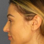 Rhinoplasty Before & After Patient #9781