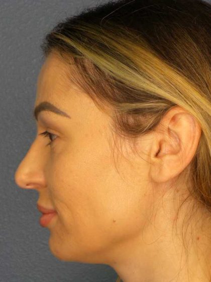 Rhinoplasty Before & After Patient #9781