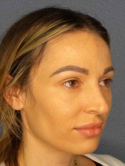 Rhinoplasty Before & After Patient #9781