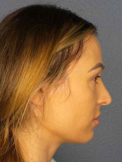 Rhinoplasty Before & After Patient #9781