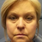 Filler Before & After Patient #7619