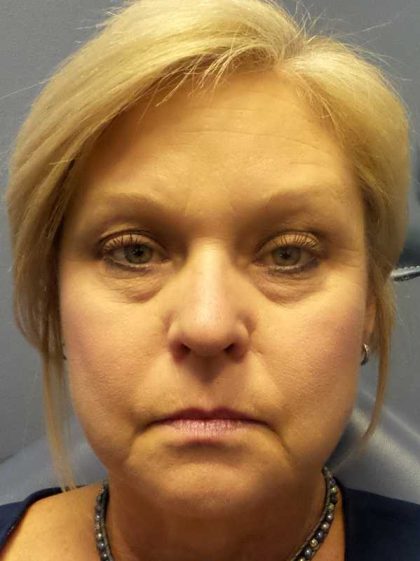 Filler Before & After Patient #7619