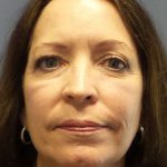 Filler Before & After Patient #7599