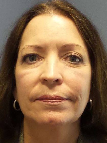Filler Before & After Patient #7599
