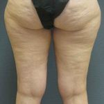 Liposuction Female Before & After Patient #7698