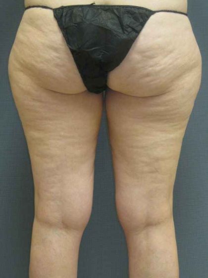 Liposuction Female Before & After Patient #7698