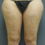 Liposuction Female Before & After Patient #7698