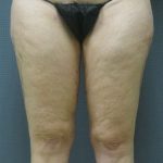 Liposuction Female Before & After Patient #7698