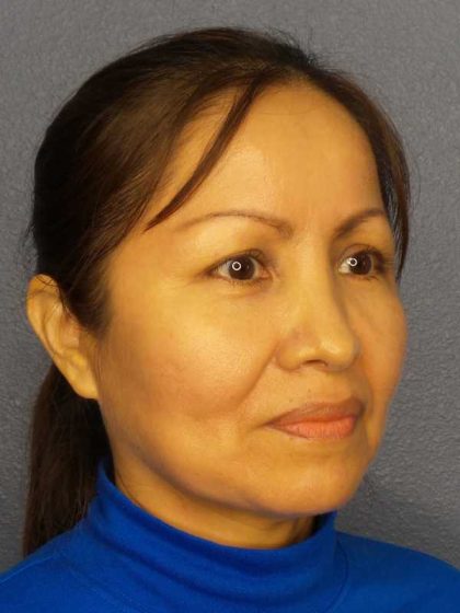 Rhinoplasty Before & After Patient #9913