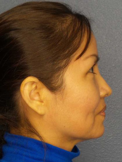 Rhinoplasty Before & After Patient #9913