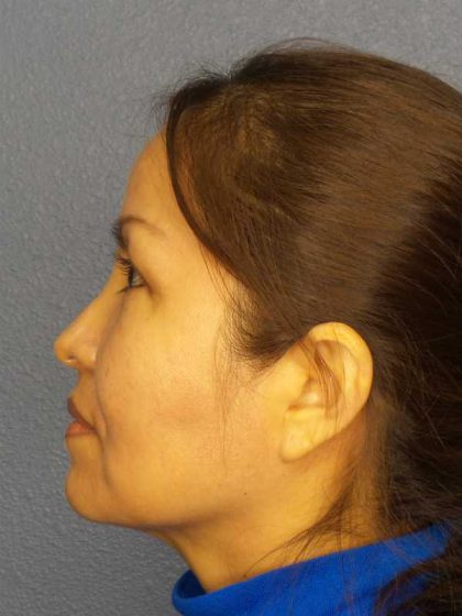 Rhinoplasty Before & After Patient #9913